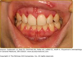 Image result for Labial mucosa