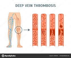 Images Vein Cartoon Cartoon Deep Vein Thrombosis