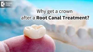 Check spelling or type a new query. How Necessary Is It To Cap Or Crown Teeth After The Root Canal Process Dr Vahini Reddy Youtube