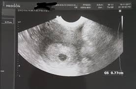 Bayi sekarang sebesar jeruk nipis! Download Ukuran Kantong Kehamilan Usia 5 Minggu Pictures Pbsafety