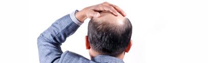 Check spelling or type a new query. Alopecie Androgenique Definition Et Symptomes Sante Sur Le Net