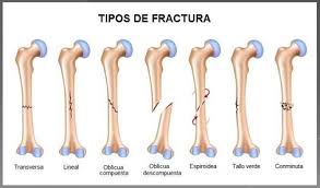 Capoeira Madrid Bone Fracture Types Of Bones Types Of Fractures