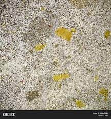 Undigestive Muscle Fiber In The Human Stool Sample Under Microscopic Examination Stool Sample Stool Medical Laboratory
