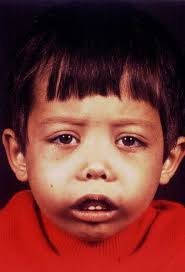 Thalassemia: Pathophisiology and treatment update” Dr. Ricardo Helman  Hospital Israelita Albert Einstein São Paulo