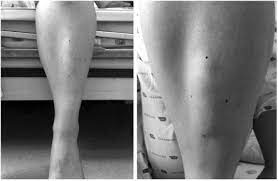 Anterior Tibial Muscle Hernia Treated With Local Periosteal Rotational Flap A Case Report