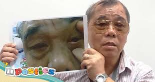 How could doctors forget to remove my sutures? Cataract patient has  surgical thread stuck in eye for two years