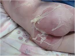Staphylococcal Scalded Skin Syndrome In A 4 Year Old Child A Case Report Journal Of Medical Case Reports Full Text