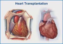 Best Heart Transplant Centers In India Offer High Success Rate Solutions Heart Transplant Heart Surgeon Transplant