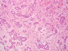 Image result for Glomus tumor