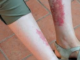 A้ฆ apar simptome urticaria este de obicei destul de pruriginoasa si poate dura doar cate minute sau mai multe zile inainte sa dispara. Ce Este Vasculita Farmacia Dona