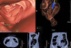 A colonoscopy is a test used to screen for cancer and investigate intestinal problems. Virtual Colonoscopy Vs Regular Colonoscopy Pros Cons