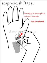 Image result for Scaphoid Shift Test