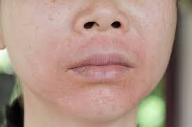 Die kleinen, roten äderchen im gesicht werden auch teleangiektasien genannt und sind bei couperose zu beginn vorübergehend, später ständig erweitert. Periorale Dermatitis Was Tun Gegen Pusteln Rotungen Im Gesicht Hautinfo