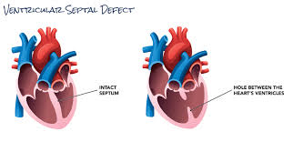 Image result for Ventricular Septal Defect