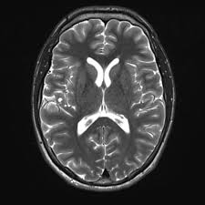 Pleomorphic xanthoastrocytoma what do we really know about it? Pleomorphic Xanthoastrocytoma Radiology Reference Article Radiopaedia Org
