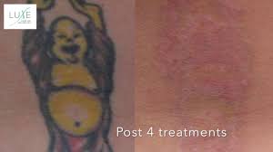 Find the relevant solution to your question. Tattoo Removal Specialist Cedar Park Tx Luxe Laser And Wellness Spa Laser Medical Spa