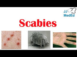 Image result for scabies transmission