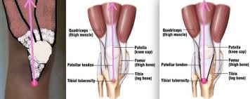 Image result for Patella Tracking Assessment