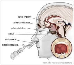Image result for Acromegaly