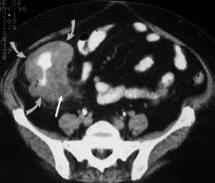 Often the doctor will recommend a ct scan for a detailed examination of internal organs such as the large. Spiral Ct Of Colon Cancer Imaging Features And Role In Management Radiographics