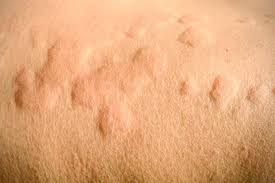 3 Women Living With Chronic Hives Chronic Hives Itchy Skin Remedy Urticaria