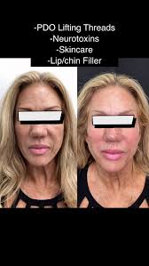 “Mastering the art and science of aesthetic medicine — one precision  injection at a time.”, At 4EverYoung Fleming Island, I specialize in  advanced techniques with:, • Neurotoxin placement for flawless ...