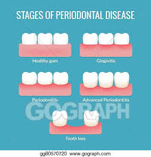 Eps Vector Periodontal Disease Chart Stock Clipart