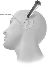 Image result for Ear Nerve Block