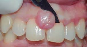Image result for granuloma gum disease
