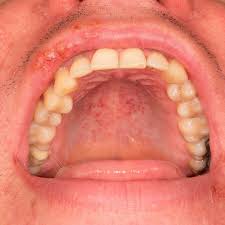 Image result for Hand foot and mouth disease HFMD roof of mouth