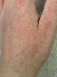 Rote Punkte Ausschlag Auf Der Hand Gesundheit Und Medizin Haut Solarium