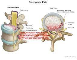 Annular Tear Nerve Irritation Spine Surgery Annular Spine Health