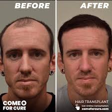 Hair Transplant Reviews