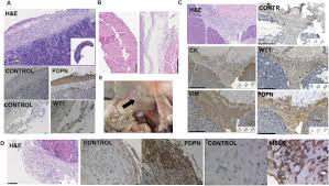 Mesothelioma treatments are available, but for many people with mesothelioma, a cure isn&#x27;t possible. How Asbestos Drives The Tissue Towards Tumors Yap Activation Macrophage And Mesothelial Precursor Recruitment Rna Editing And Somatic Mutations Biorxiv