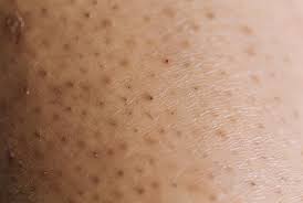 Bacteria that normally reside on the skin's surface may collect in the follicle, producing an infected ingrown hair. How To Treat Prevent Ingrown Hairs Dr Pimple Popper