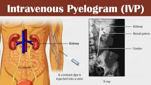 Image result for Intravenous Pyelogram