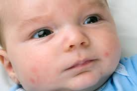 Sarpullido Por Calor En Bebes Y Ninos Como Evitarlo Planeta Mama