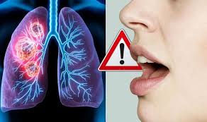 Genetic factors also may play a role in one's chances of developing lung cancer. Lung Cancer Symptoms Does Your Voice Sound Like This The Change When You Speak Sound Health And Lasting Wealth