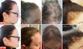 Hair loss affects only intellectuals. Women Who Lost Their Confidence Because Of Balding Hair Hail 35 A Month Protein Capsules Daily Mail Online