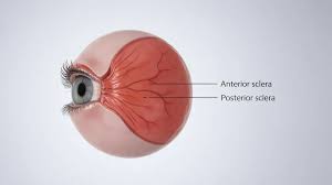 Image result for Scleritis