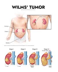 Image result for Nephroblastoma