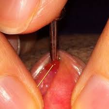 We'll also give you advice on when to call your doctor. Trouble With Scarring On Vertical Clit Hood Vch Pierc