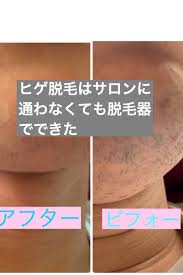 髭脱毛で脱毛器ならトリア一択な理由 ケノンと脱毛ラボを旦那に使わせてみてわかったこととは りこの美容脱毛チャンネル face names