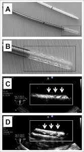 Echographic Image Of A Single Stage Drainge Cannula Tip A