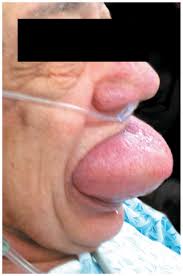 Angioedema | Dr. Qaisar Ahmed | Homeopathic | Best Homeopathic Doctor in Pakistan | Dr. Qaisar Ahmed MD, DHMS