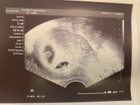 Ab wann sieht man das geschlecht des babys im ultraschall? Sieht Man Das Geschlecht Forum Madchen Oder Junge Urbia De