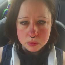 I have a special prayer request. It's for my daughter Cassidy. We have been  battling what we thought was atopic dermatitis and we recently found out by  special bloodwork and examinations from