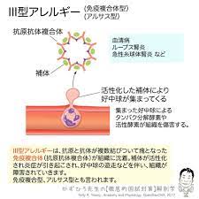 iii型アレルギー 免疫複合型 アルサス型 iii型アレルギーは 抗原と抗体が複数結びついて塊となった免疫複合体 抗原抗体複合体 が組織に沈着 補体が活性化され炎症が引き起こされ 好中球の遊走などを伴い 組織が障害されていきます 免疫複合型 アルサス型
