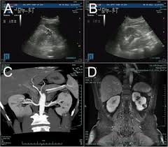 Renal cell carcinoma (rcc), which arises from renal tubular epithelium, is the most common cause of renal malignancy in adults. Cystic Renal Cell Carcinoma A Report Of 67 Cases Including 4 Cases With Concurrent Renal Cell Carcinoma Bmc Urology Full Text