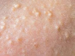 White Spots On The Skin Possible Causes And Treatments